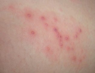 湿疹临床症状表现