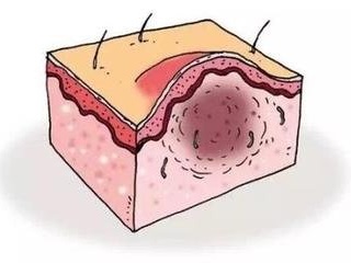 毛囊炎要如何护理