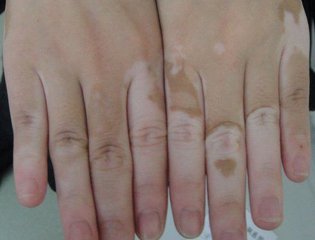 白癜风初期症状