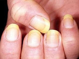 灰指甲是怎么引起的