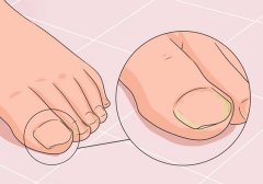 成都医院治灰指甲