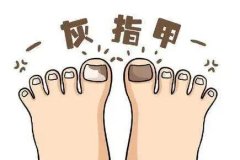 成都看灰指甲哪家医院好